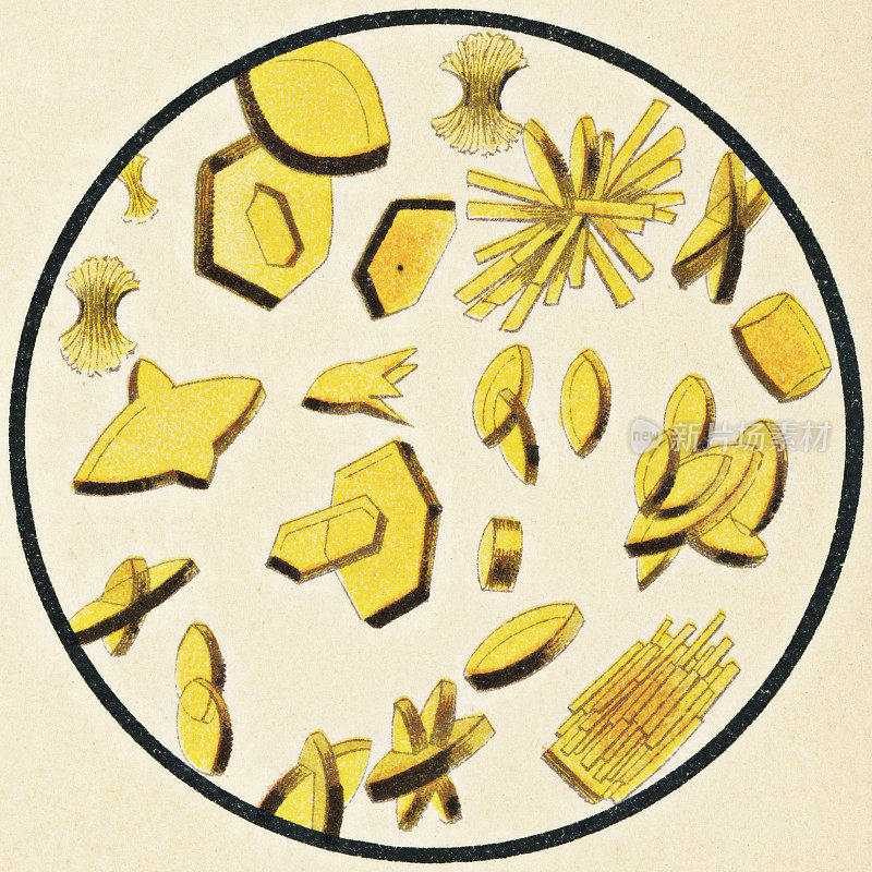 人类尿液中尿酸晶体的显微镜观察- 19世纪